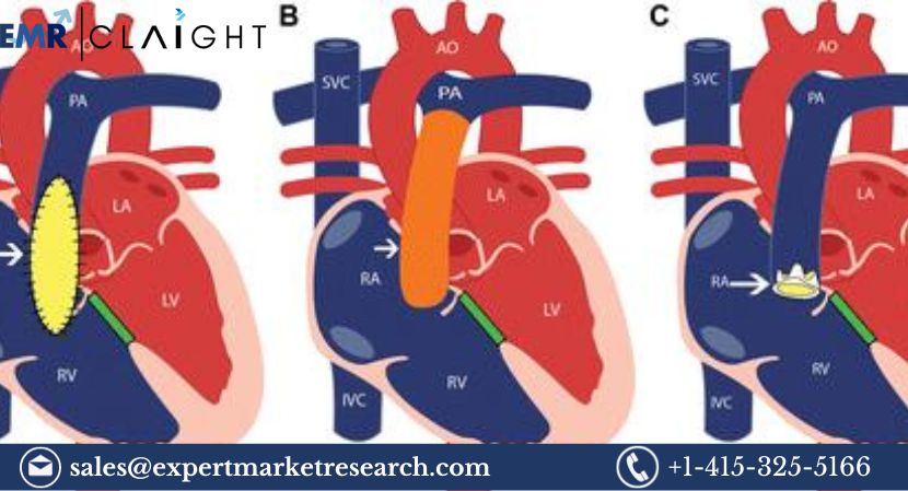 Transcatheter Pulmonary Valve Market