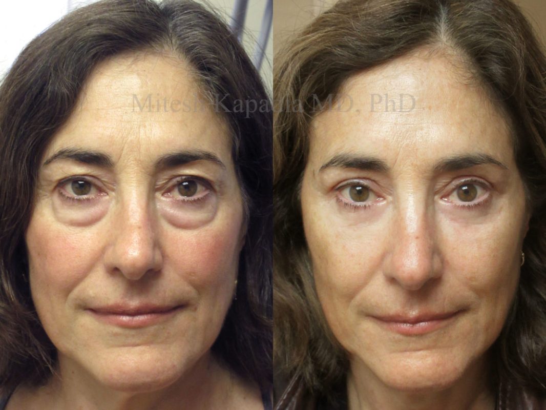 eyelid surgery in dubai