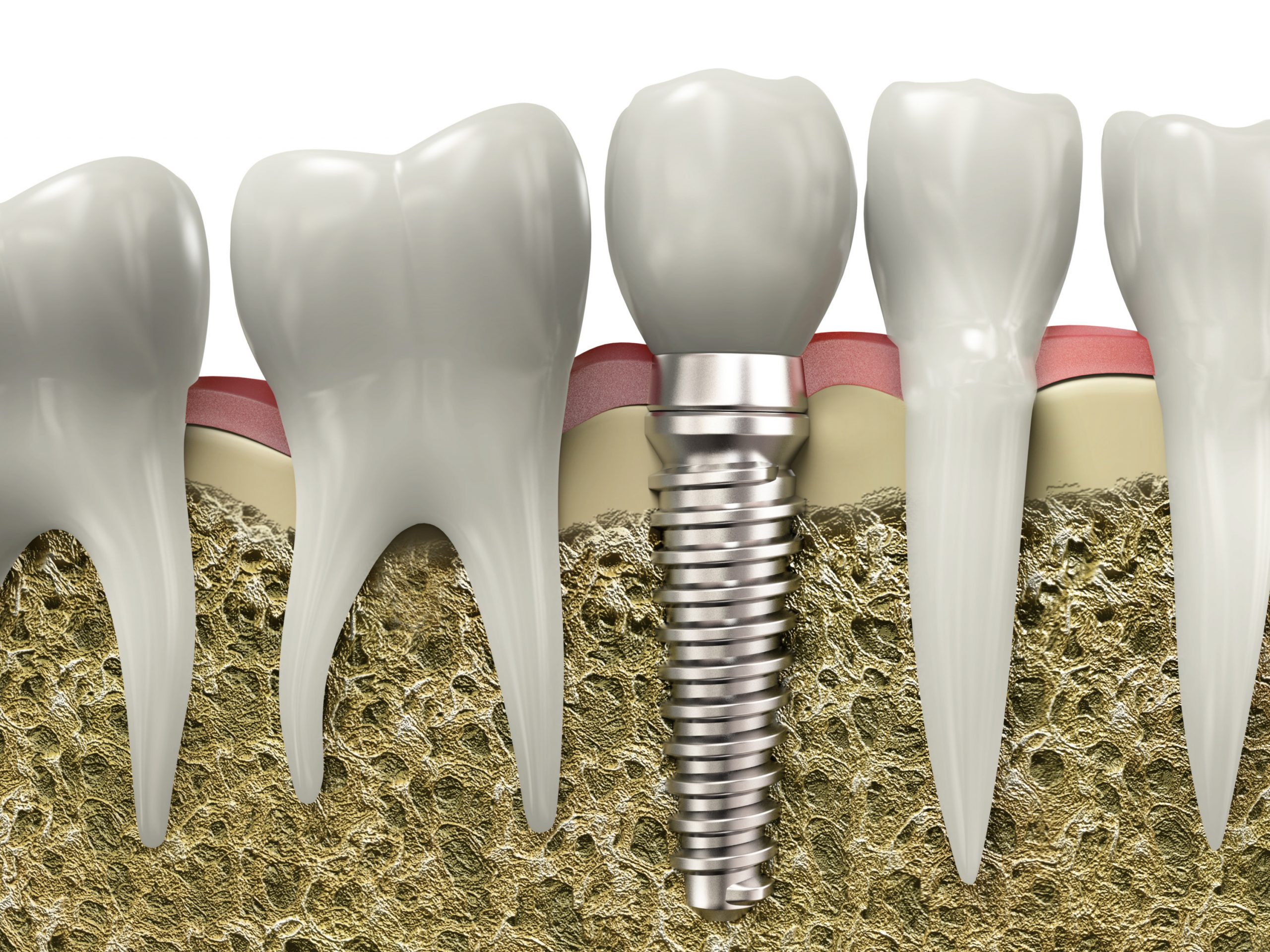 dental bridge houston