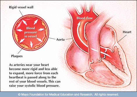 hypertension