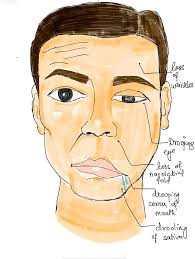 Bell's Palsy